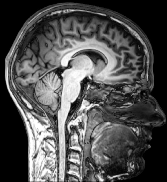 Ressonância magnética de um cérebro humano em corte sagital